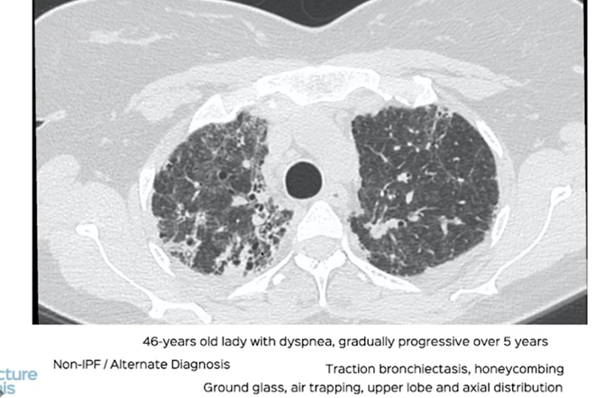 Imaging Updates in ILD