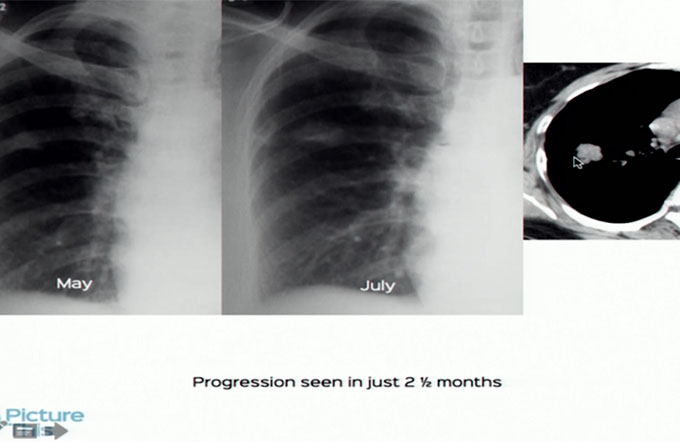 Solitary lung nodule
