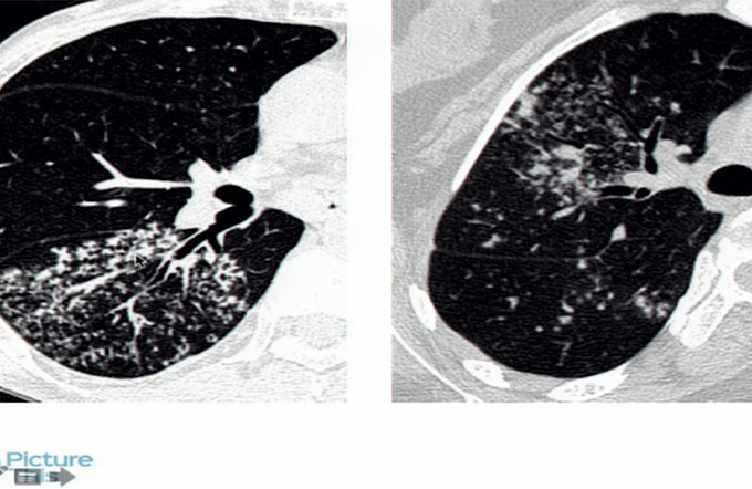 Large Airways, Small Airways, Emphysema