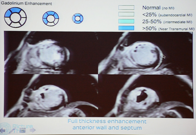 Cardiac MR - Role in Viable Imaging