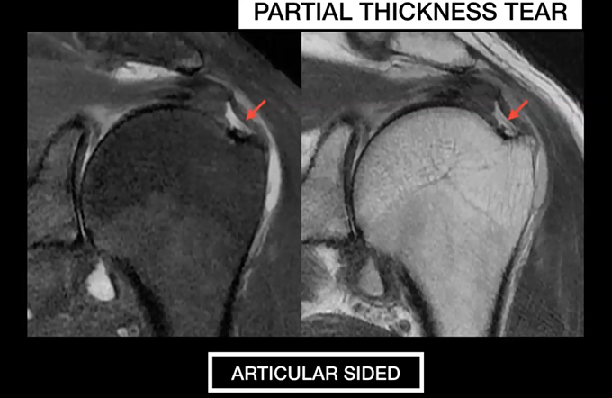 Bone tumors, Knee, Shoulder