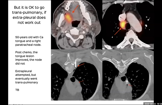 CT Guided Chest Biopsy