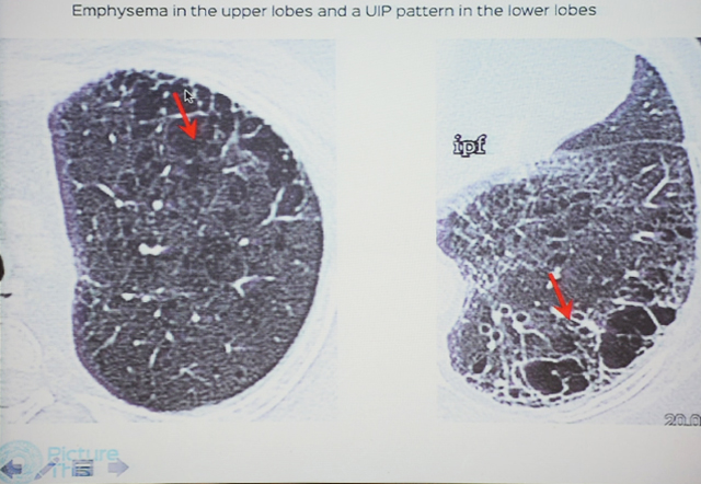 Glossary in HRCT & Brief Overview of Smoking Related ILD