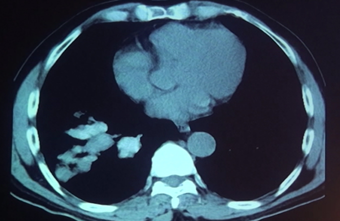 Approach To Airway Disease