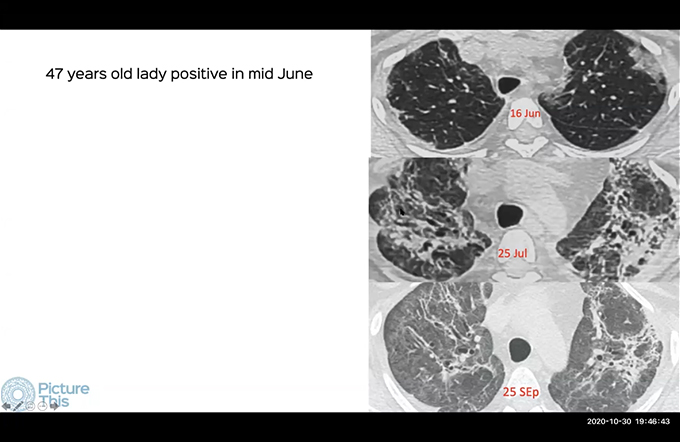 CT scan of the chest in COVID 19