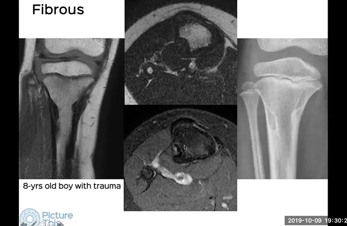 Approach to Bone Tumors - Rule of 8 - Part II