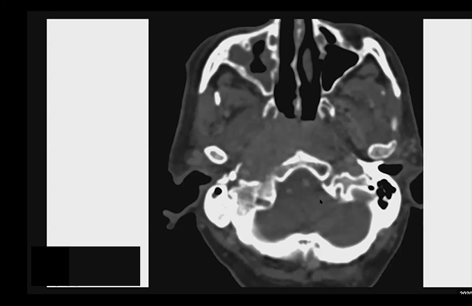 CT guided biopsies - case based