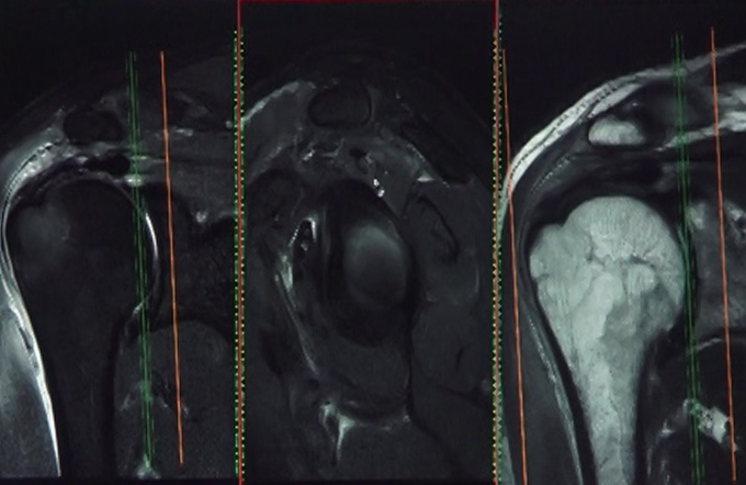 Internal Derangements - Part I