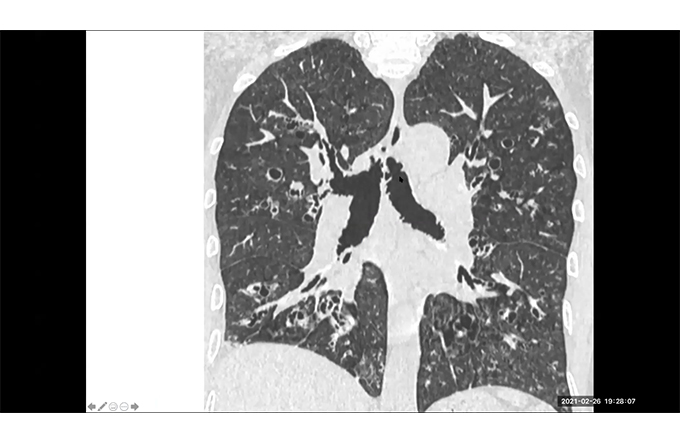 Large and small airways disease