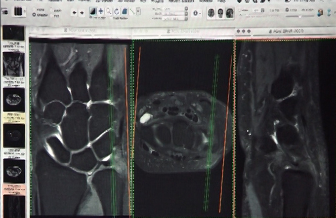 Internal Derangements - Part II