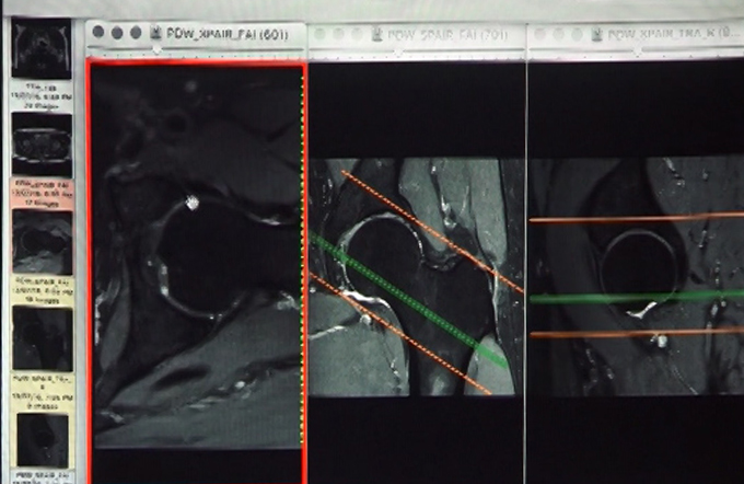 Internal Derangements - Part III
