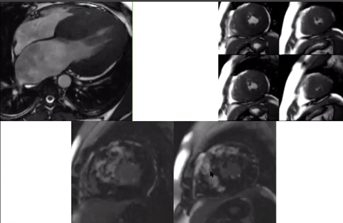 Non-ischemic cardiomyopathies