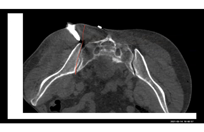 Only Cases - CT Guided Biopsies