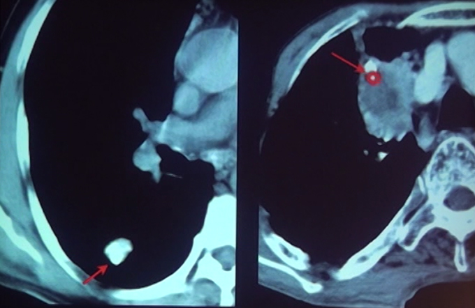 Solitary Pulmonary Nodule Part - I