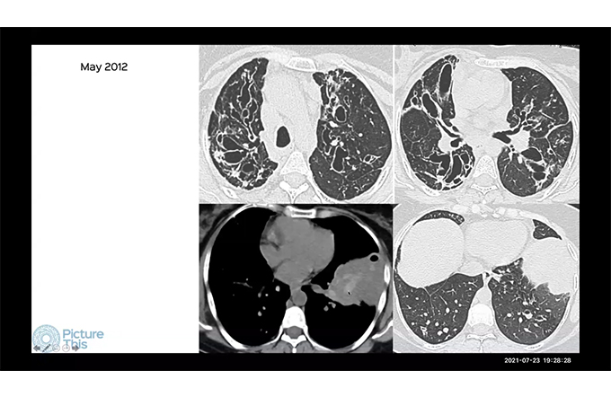 Covid 19 One Year Later