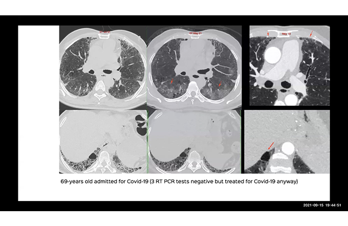 Fungal Diseases of the Chest