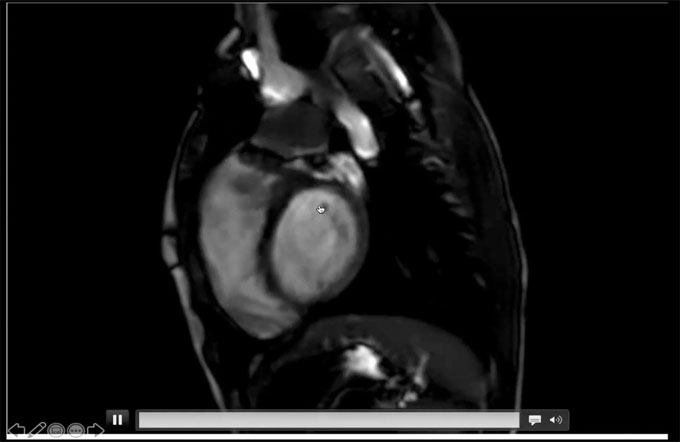 Cardiac MRI basics - wall motion abnormality and scan planes