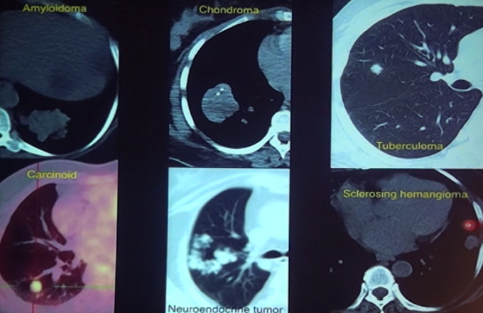 Solitary Pulmonary Nodule Part - II