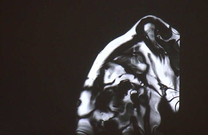 Case Discussion: Non- Ischemic Cardiomyopathies Part I