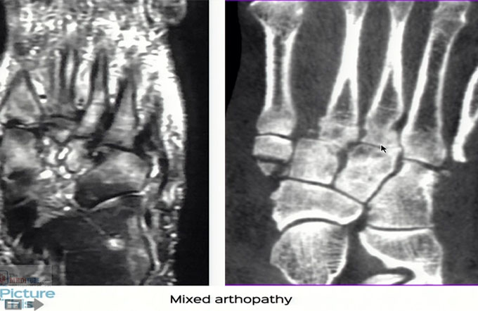 When is it an arthritis