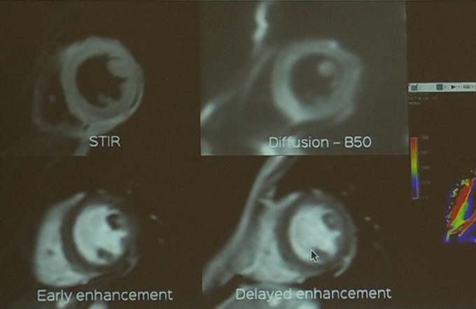 Role of T1 Mapping in Non-Ischemic Cardiomyopathies