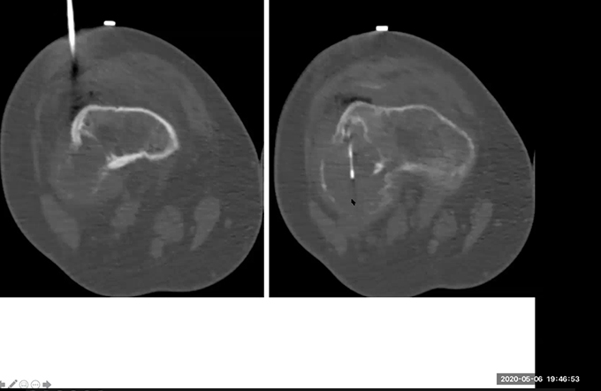 CT guided bone biopsies