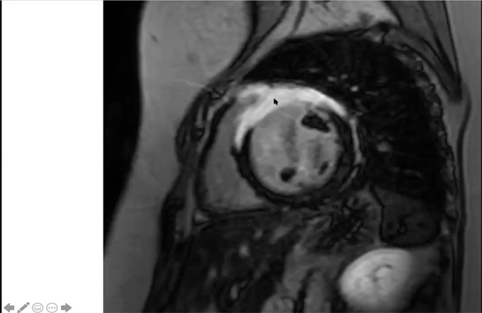 Cardiac MRI - enhancement patterns & viability imaging