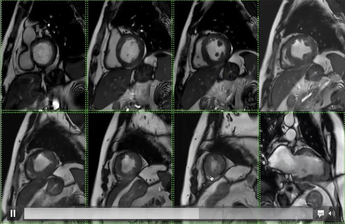 Cardiac MRI - understanding viability through cases