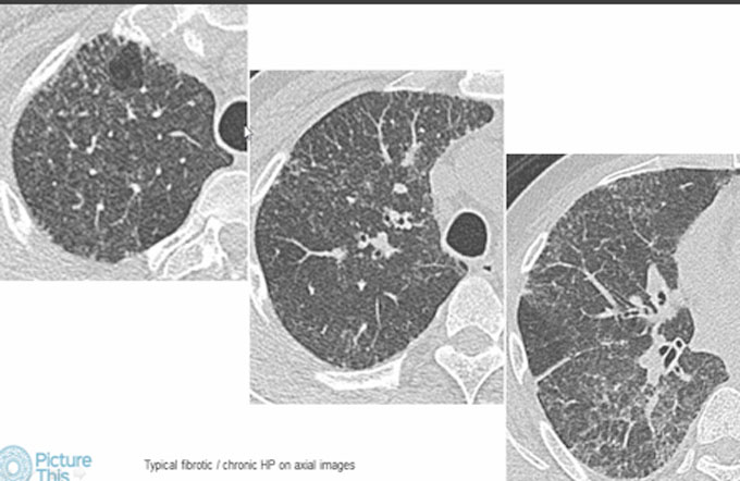 Hypersensitivity Pneumonitis (HP)