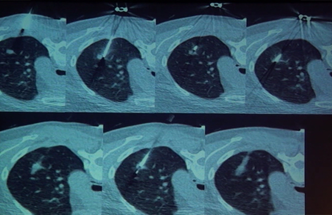 CT Guided Biopsy - Approach Part - I