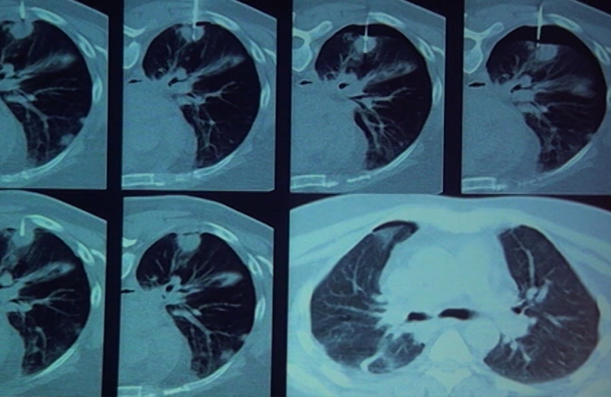 CT Guided Biopsy - Approach Part - II