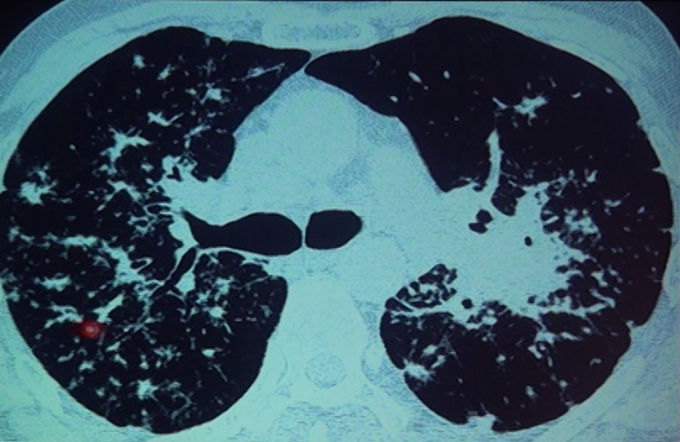 Approach To Interstitial Lung Disease Part - II