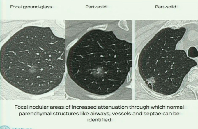 Imaging in Solitary Lung Nodules