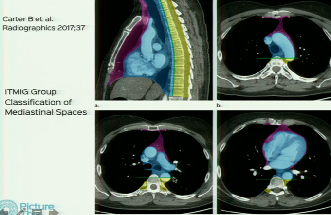 Imaging in Mediastinum