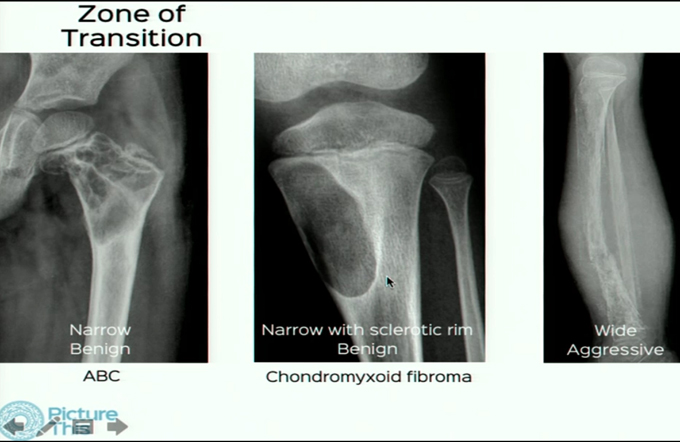Evaluation of Focal Bone lesions