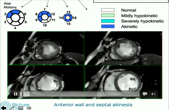 An Overview on Cardiac MRI -Indications and Techniques