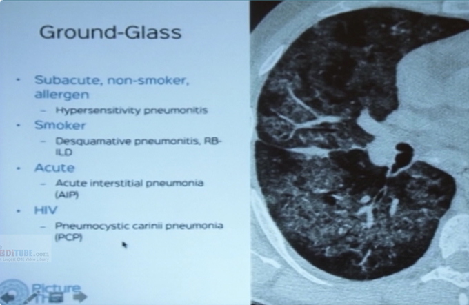 Setting the stage- Fibrosing versus Non-fibrosing and Why this differentiation is important