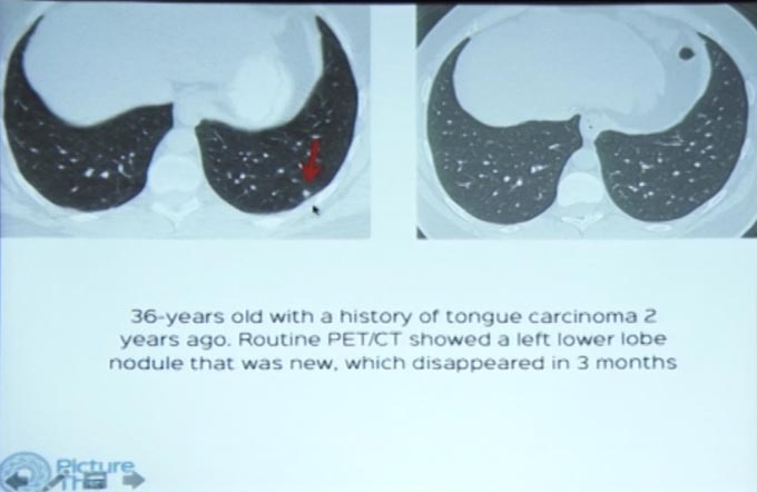 A Practical Approach to Solid Lung Nodules