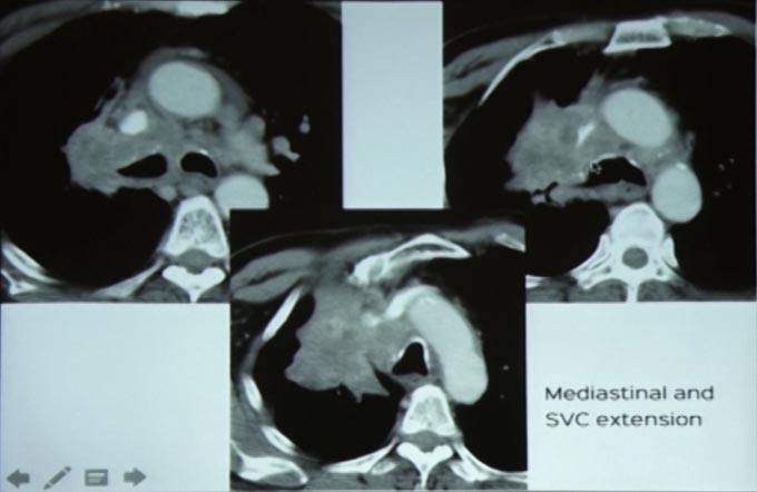 Lung cancer the many forms of presentation
