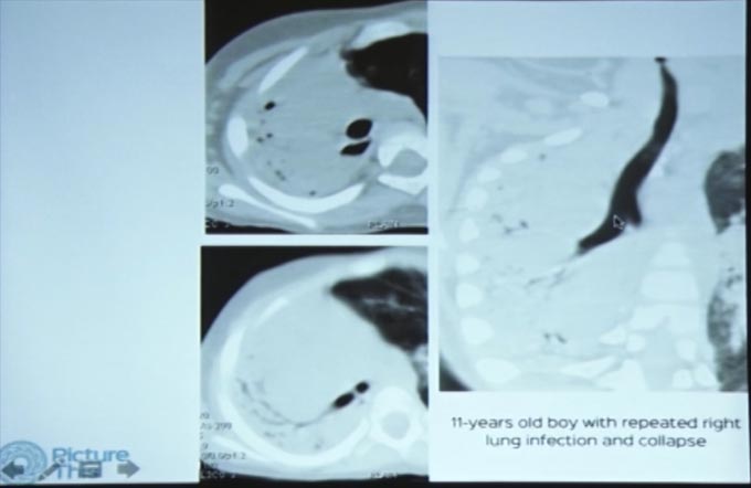 Case Based Discussion on Bronchiectasis, Emphysema and Airway Diseases - Part I