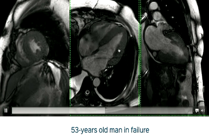Cardiac MRI Beyond Viability