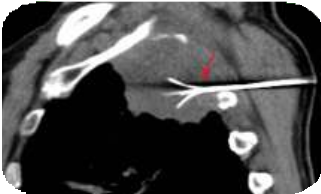 Radiofrequency Ablation (RFA) of Lung Tumors