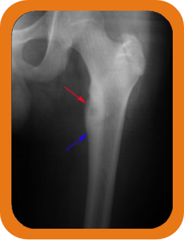 Radiofrequency Thermal Ablation of Osteoid Osteomas