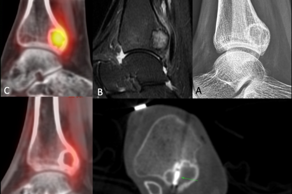 Cryoablation of Chondroblastoma