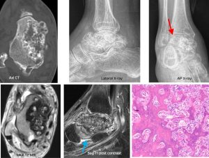 MRI of bone-forming lesion in the talus