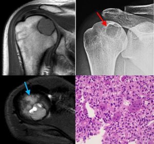 Chondroblastoma MRI shows a focal osteolytic lesion in the epiphysis of the proximal humerus