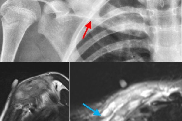 The Concept of Benign Aggressive Bone Tumors