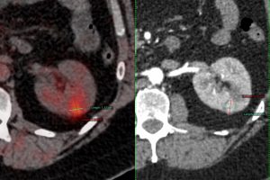 cryoablation-of-renal-tumors-2