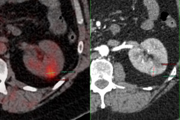 Cryoablation of Renal Tumors