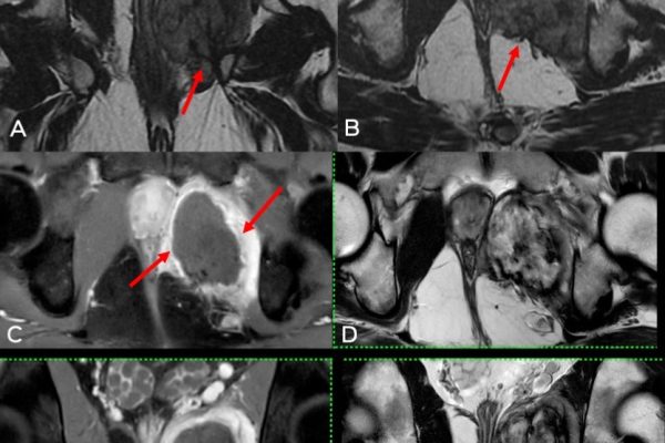 Cryoablation of Pelvic Fibromatosis